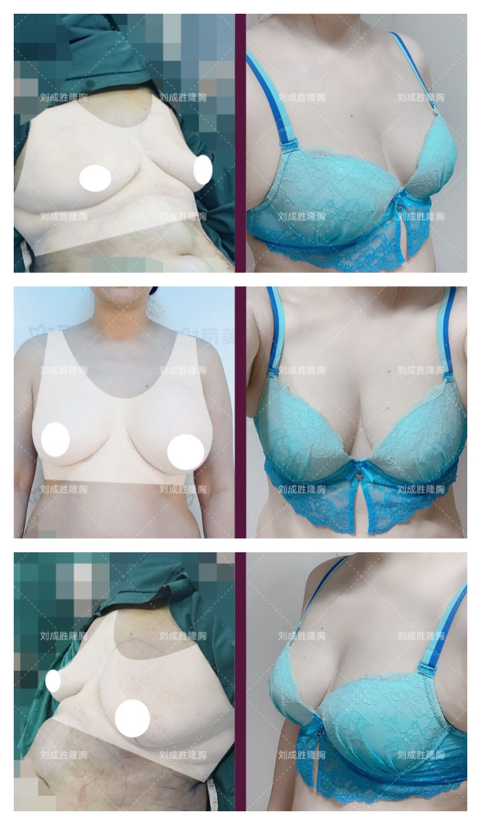 奥美定取出后多长时间适合植入假体：详细解析